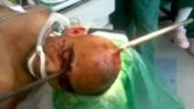 Un pieu à travers le crâne, il se rend conscient à l'hôpital (VIDEO) Un pieu à travers le crâne, il se rend conscient à l'hôpital (VIDEO)