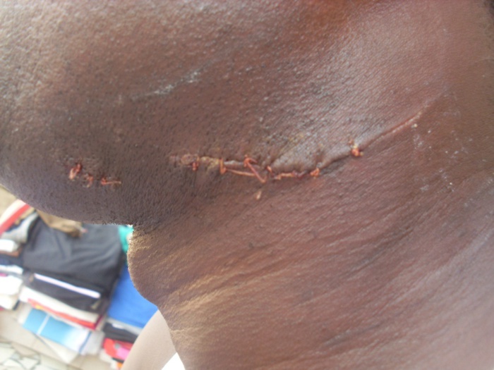 TOUBA- ÉGORGÉ, BABACAR NDIAYE DIT PAPE, ÉCHAPPE A LA MORT : Mon seul tort : « avoir dénoncé un voyou à la police! » TOUBA- ÉGORGÉ, BABACAR NDIAYE DIT PAPE, ÉCHAPPE A LA MORT : Mon seul tort : « avoir dénoncé un voyou à la police! »