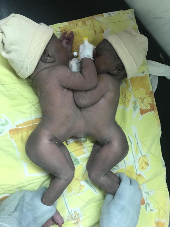 Opération réussie à l’hôpital Albert Royer pour deux bébés siamois de 49 jours. Opération réussie à l’hôpital Albert Royer pour deux bébés siamois de 49 jours.
