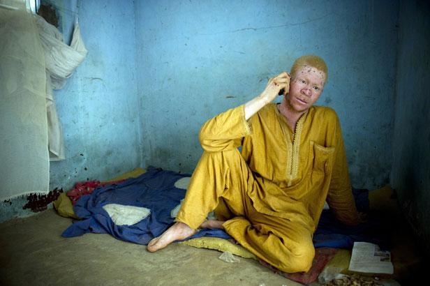 Sénégal: la peur s'empare des albinos.