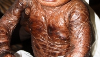 «Mon fils est né avec une peau lézardée, sans paupières…»