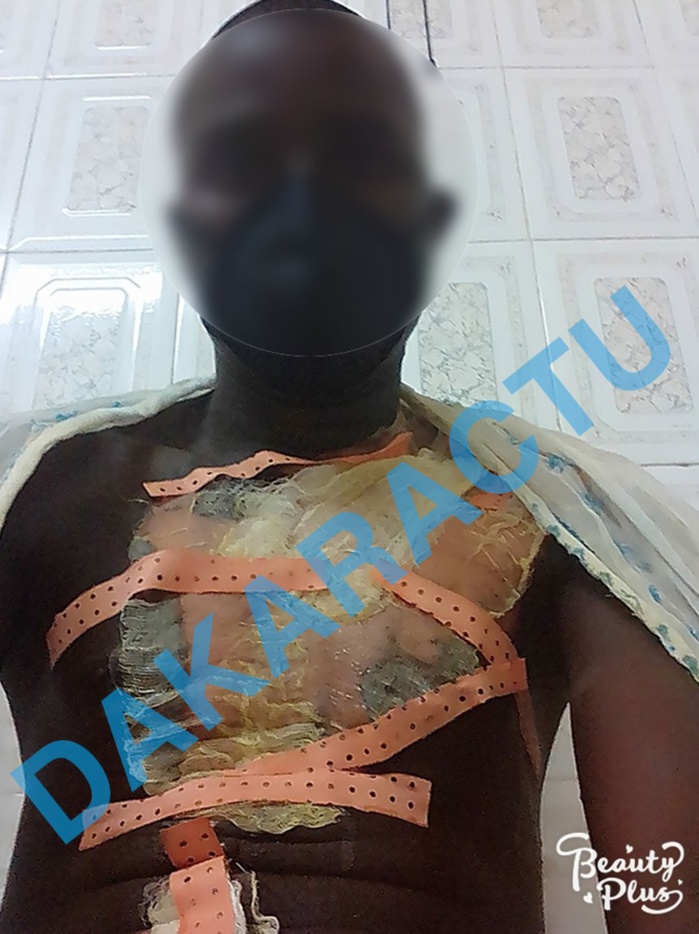 Fait divers à Touba : Un tailleur ebouillanté par son épouse.