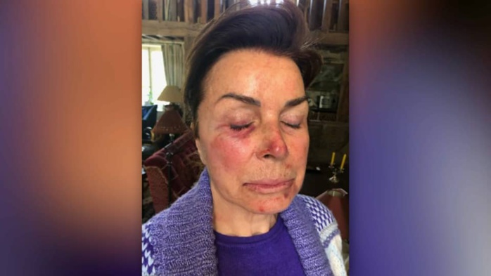 Les photos des blessures des époux Tapie après leur violent cambriolage. Les photos des blessures des époux Tapie après leur violent cambriolage.