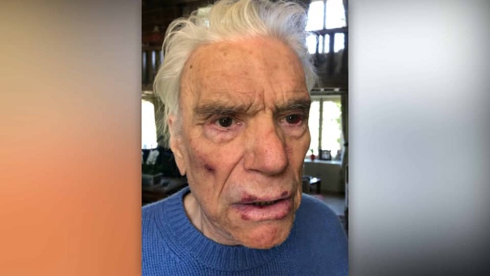 Les photos des blessures des époux Tapie après leur violent cambriolage. Les photos des blessures des époux Tapie après leur violent cambriolage.