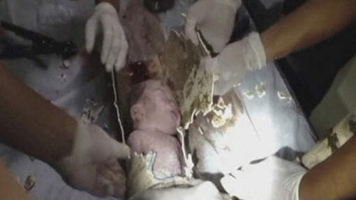 L'incroyable sauvetage d'un bébé jeté dans les toilettes