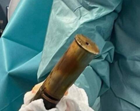 Un octogénaire débarque aux urgences avec un obus de la Première guerre mondiale coincé dans l'anus, l'hôpital évacué