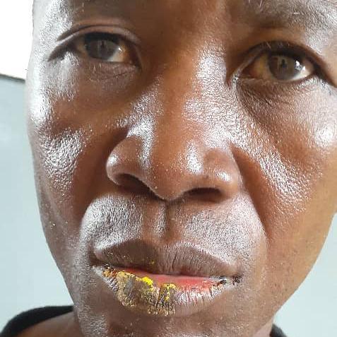 Guinée Conakry : de mystérieux boutons et taches apparaissent sur la peau des pêcheurs…