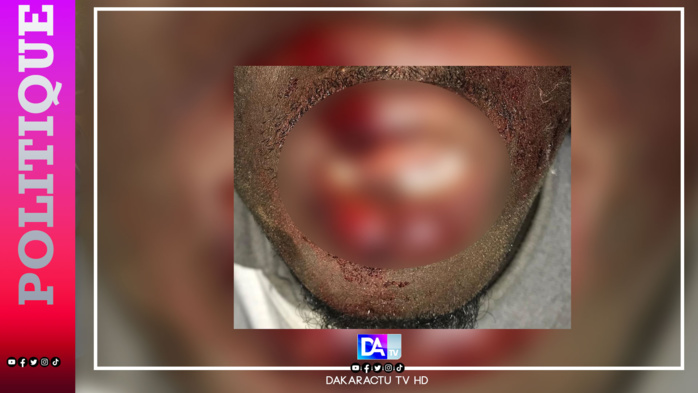 Thiadiaye / La caravane de Pastef attaquée : Un blessé grave et 07 voitures caillasées... Une plainte annoncée... Thiadiaye / La caravane de Pastef attaquée : Un blessé grave et 07 voitures caillasées... Une plainte annoncée...