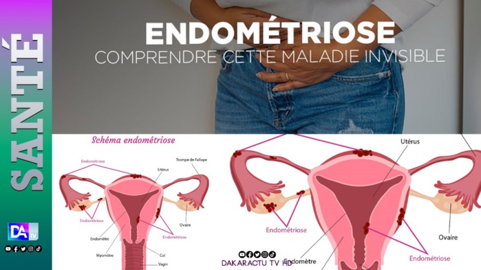 Santé : Zoom sur l'endométriose, cette maladie qui gâche la vie des femmes Santé : Zoom sur l'endométriose, cette maladie qui gâche la vie des femmes