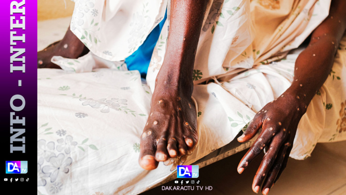 Mpox en Afrique: près d'un million de doses de vaccin attendues Mpox en Afrique: près d'un million de doses de vaccin attendues