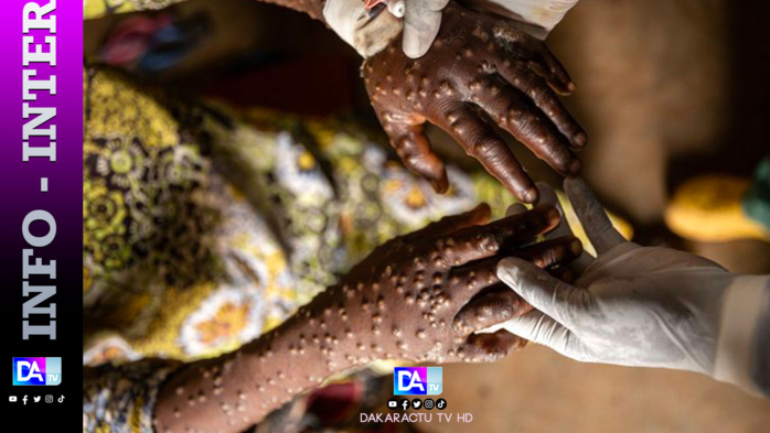 Premier cas de mpox en Guinée Premier cas de mpox en Guinée