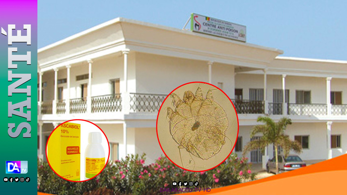 Santé : Le Centre Anti-Poison alerte les pharmaciens sur une intoxication à l'Ascabiol Santé : Le Centre Anti-Poison alerte les pharmaciens sur une intoxication à l'Ascabiol