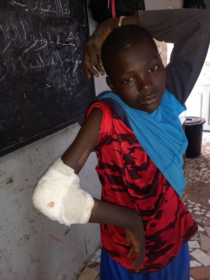 Victime d’accident : Un Talibé sollicite l’aide des bonnes volontés pour sa prise en charge médicale