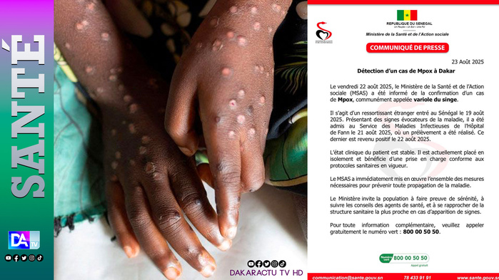 Dakar : un premier cas de Mpox confirmé