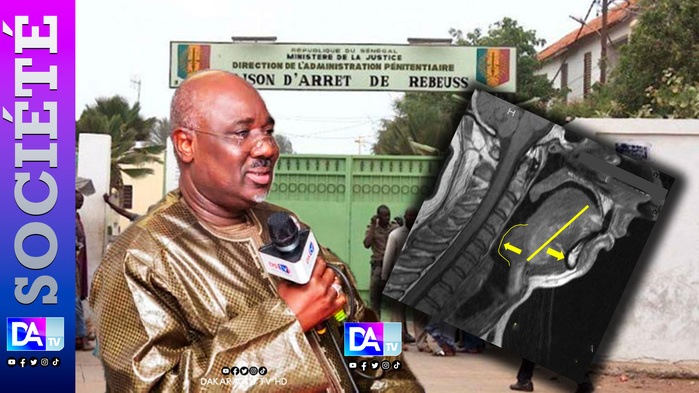 Affaire Farba Ngom : la prison, une bombe à retardement pour sa santé ? La contre-expertise qui alerte sur un risque de « mort subite nocturne » Affaire Farba Ngom : la prison, une bombe à retardement pour sa santé ? La contre-expertise qui alerte sur un risque de « mort subite nocturne »