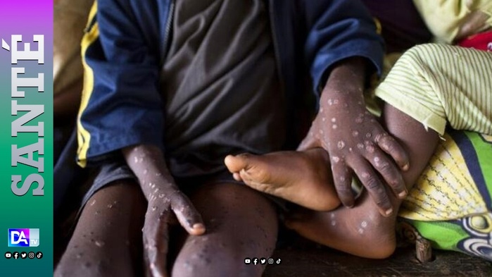 Santé : Un deuxième cas de MPOX confirmé par le Ministère de la santé Santé : Un deuxième cas de MPOX confirmé par le Ministère de la santé