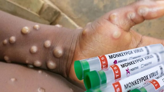 Santé: L’essentiel à retenir sur le MONKEYPOX en 7 points Santé: L’essentiel à retenir sur le MONKEYPOX en 7 points