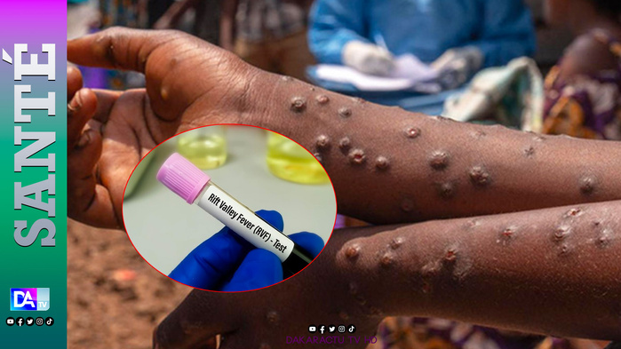 Fièvre de la vallée du rift : Dakar enregistre son premier cas Fièvre de la vallée du rift : Dakar enregistre son premier cas