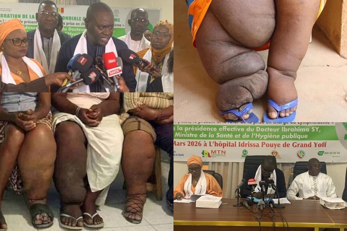 Santé : Le Sénégal célèbre une première journée mondiale du Lymphœdème et appelle à une prise en charge accessible Santé : Le Sénégal célèbre une première journée mondiale du Lymphœdème et appelle à une prise en charge accessible