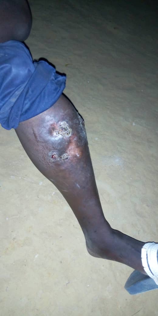 SOS / Atteint d’ulcère veineux : M.S risque l'amputation de sa jambe.