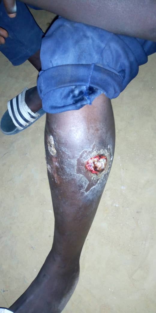 SOS / Atteint d’ulcère veineux : M.S risque l'amputation de sa jambe.