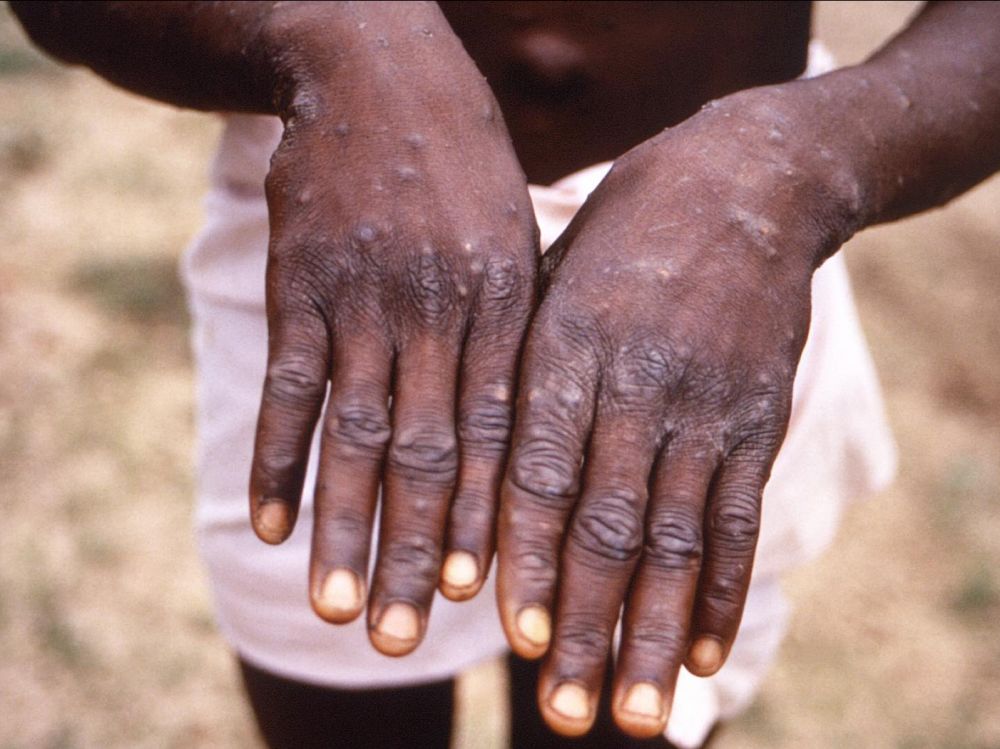 SANTÉ / 1.400 cas de variole du singe enregistré, signalés par l’OMS dans 5 pays d’Afrique