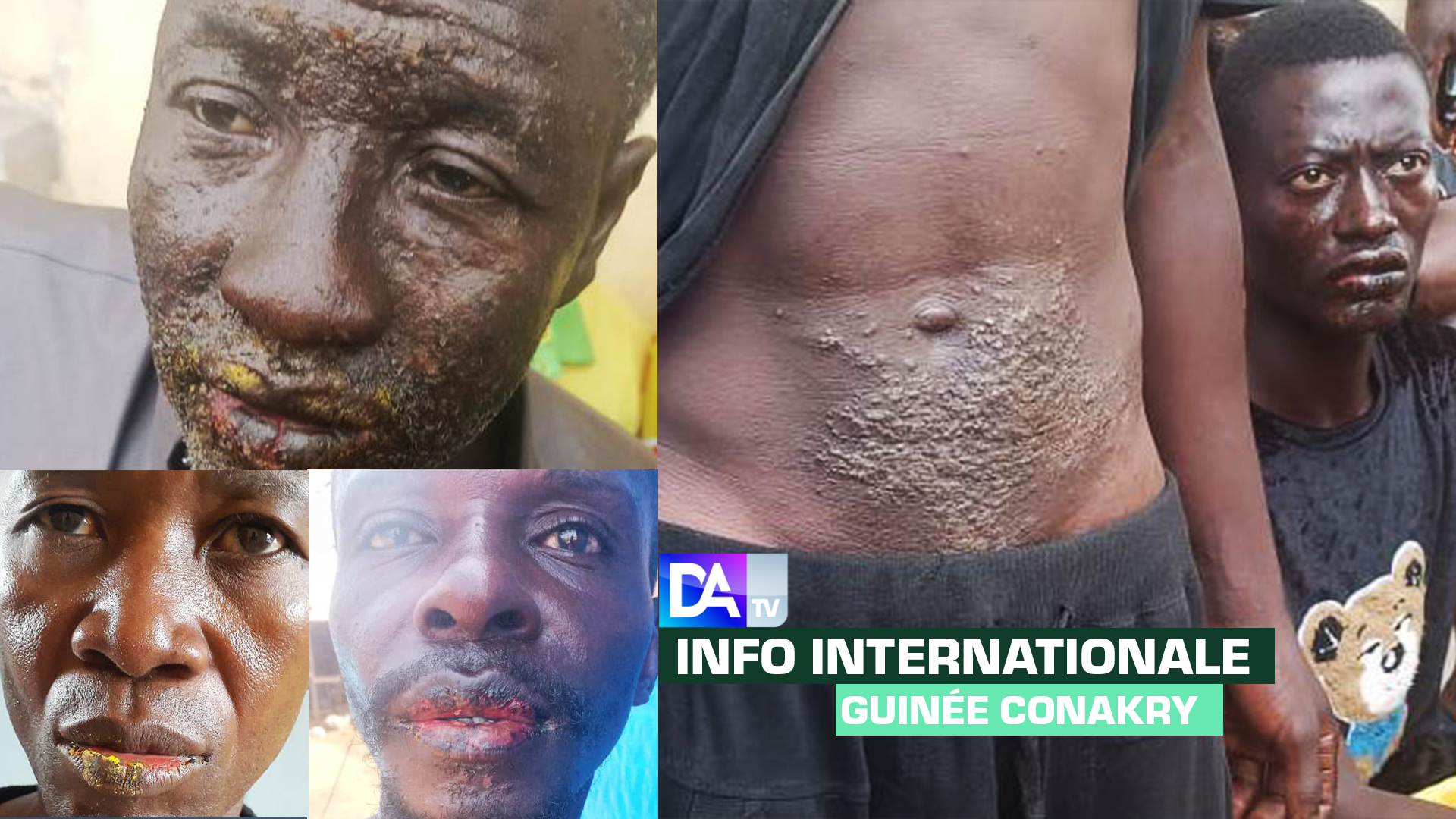 Guinée Conakry : de mystérieux boutons et taches apparaissent sur la peau des pêcheurs…