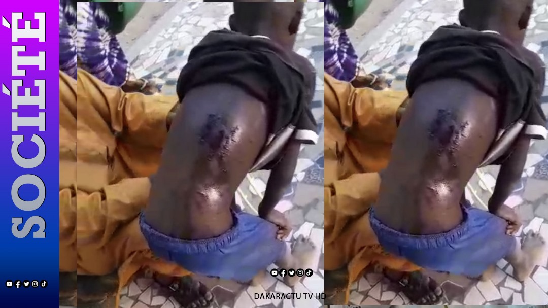 TOUBA - Un ndongo- daara maltraité, traînant une plaie horrible fracasse les âmes sensibles