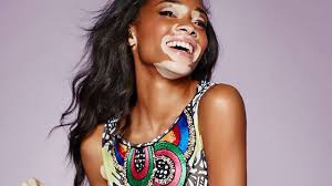 Chantelle Winnie : atteinte de vitiligo, elle défend ses fans qui tentent de lui ressembler !