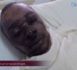 Babacar Mbaye ébouillanté par sa femme Ndèye Diallo raconte : " Je n'ai rien fait à ma femme. Elle m'a retrouvé en train de dormir et elle m'a ébouillanté" 