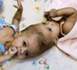 Des siamoises reliées par la tête séparées par des médecins (PHOTOS) 