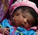 Une Sénégalaise accouche d’un enfant à deux têtes au centre de santé de Boghé