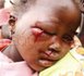 Visite de Wade à Thiès : N. D. Fall, 3 ans, l'oeil crevé par une grenade lacrymogène, sa famille demande de l'aide.
