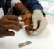 Journée mondiale du VIH/Sida : Les chiffres alarmants du taux de prévalence à Ziguinchor