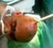 Un pieu à travers le crâne, il se rend conscient à l'hôpital (VIDEO)