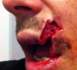 La terrible blessure d'un rugbyman grenoblois