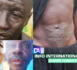 Guinée Conakry : de mystérieux boutons et taches apparaissent sur la peau des pêcheurs…
