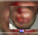 Thiadiaye / La caravane de Pastef attaquée : Un blessé grave et 07 voitures caillasées... Une plainte annoncée...
