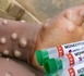Santé: ​L’essentiel à retenir sur le MONKEYPOX en 7 points