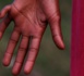 Chine: un garçon né avec 16 doigts et 15 orteils espère une opération
