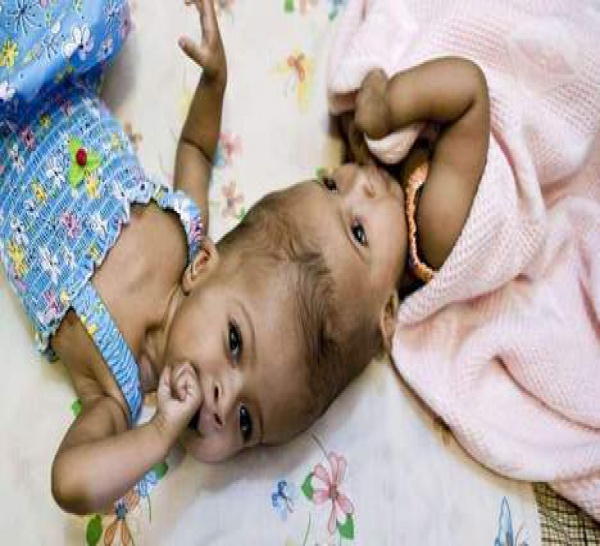Des siamoises reliées par la tête séparées par des médecins (PHOTOS) 