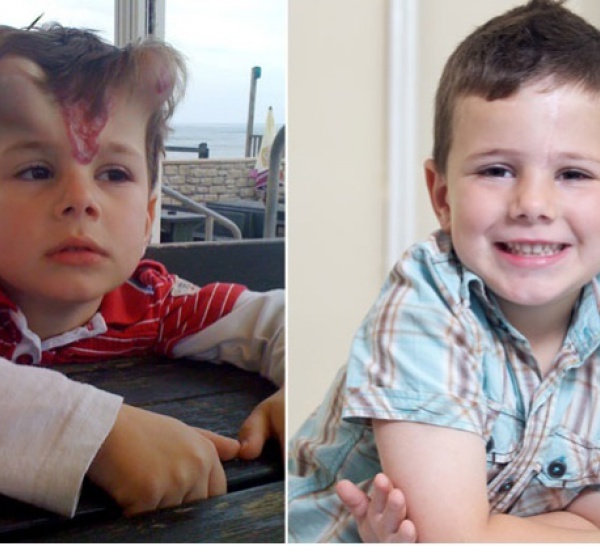 Un enfant transformé en Frankenstein pour une opération (PHOTOS)