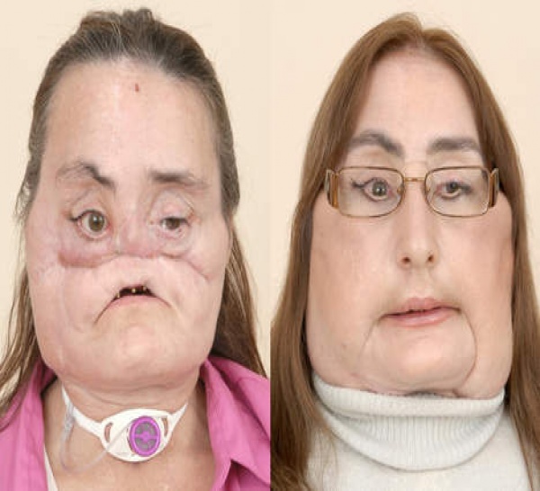 "Ce n'est pas mon visage, mais je suis heureuse d'en avoir un" ( PHOTOS )