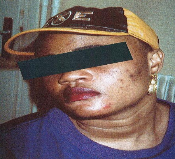 Au Sénégal, plus de 100 femmes meurent par an du fait de la dépigmentation de la peau. 