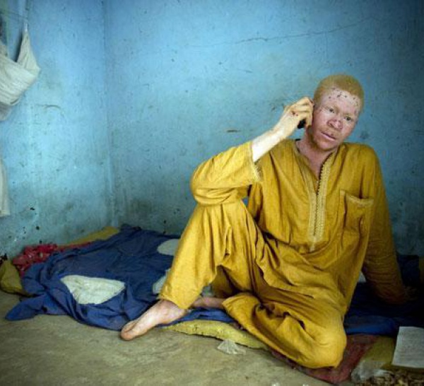 Sénégal: la peur s'empare des albinos.