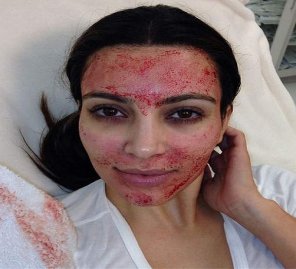 Un soin de beauté sanglant pour Kim Kardashian