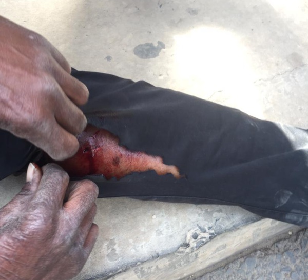 Rond-point Mermoz : Un reporter reçoit une balle à blanc à la jambe