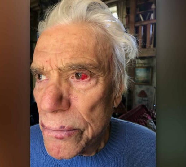 Les photos des blessures des époux Tapie après leur violent cambriolage.
