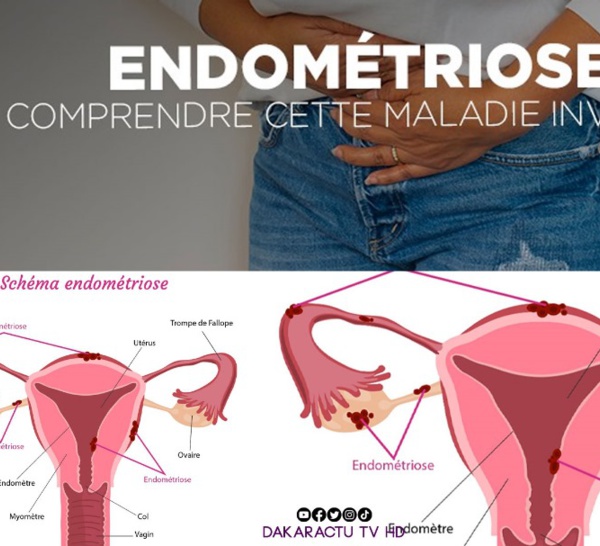 Santé : Zoom sur l'endométriose, cette maladie qui gâche la vie des femmes