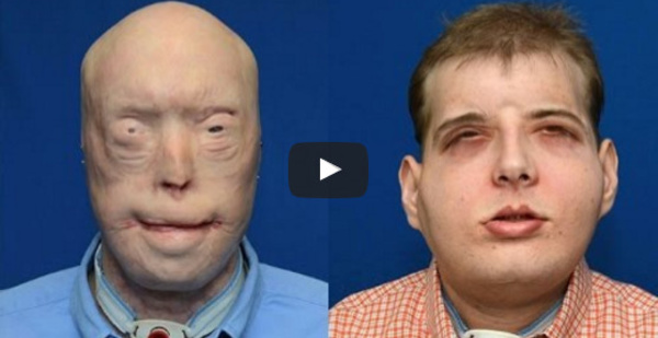Une greffe totale du visage réalisée aux Etats-Unis (video)